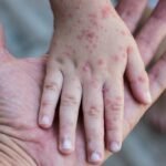 Puluhan Anak di Tasikmalaya Terjangkit Campak, Dinkes Kejar Target Imunisasi Ribuan Balita